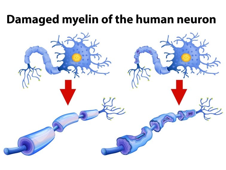 transverse myelitis symptoms